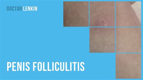 Folliculitis penile - For instance, you may get similar-looking bumps from other STIs, such as syphilis and genital warts, or skin diseases like eczema and folliculitis. Learn more about what herpes looks like and how ...
